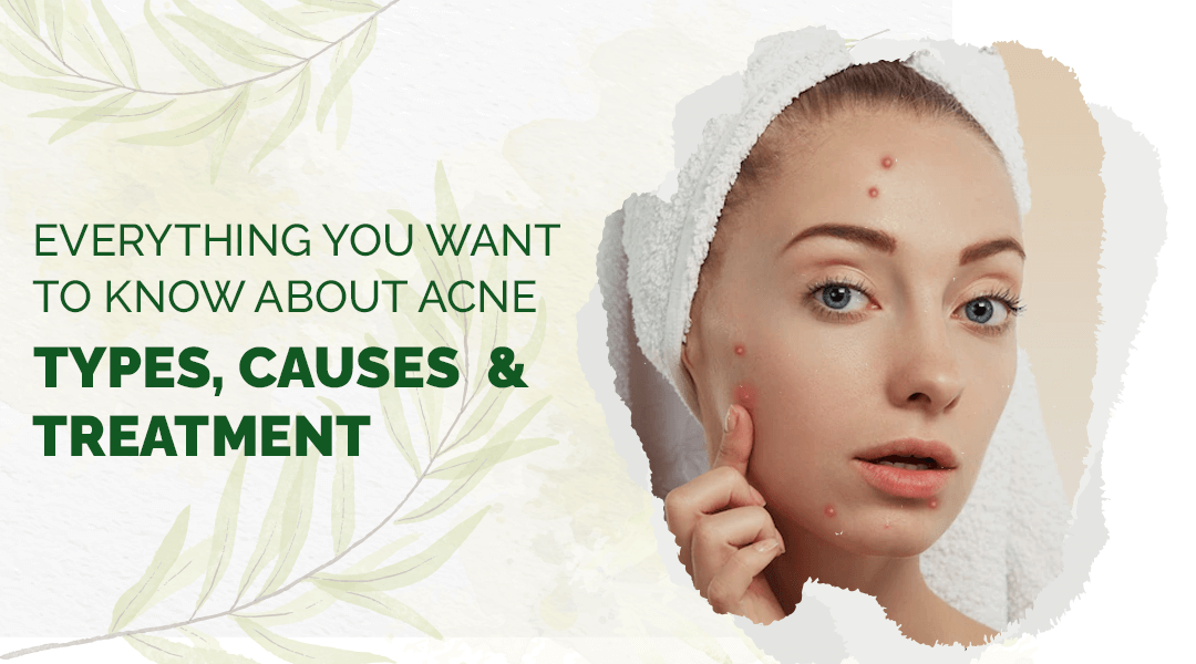 Acne :Types, Causes and treatment
