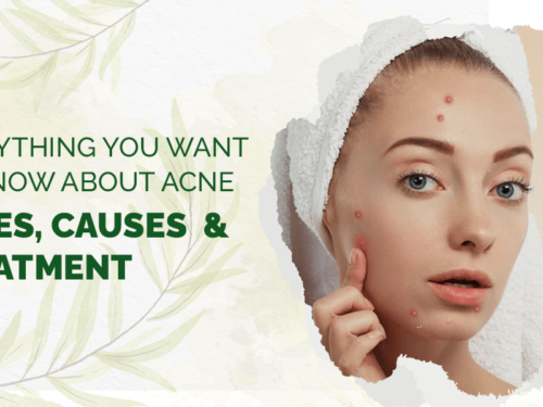 Acne: Types, Causes & Treatment | Everything You Want to Know About Acne
